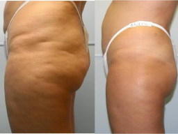 Webinar: CELLULITE - loswerden und verbessern - 3 Säulen Konzept